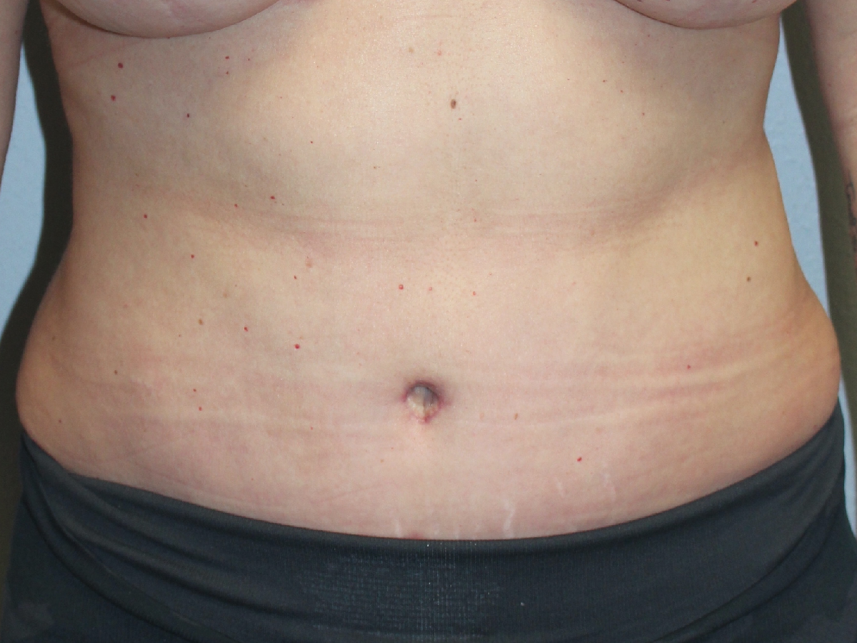 Before and after plastic surgery results in Dallas, TX, performed by Dr. Surjit Rai, MD.