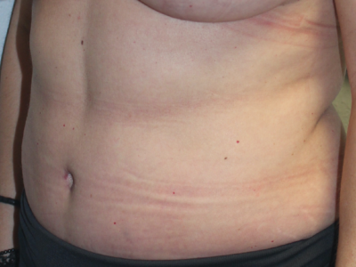 Before & After Photos: Breast Explant With Other Cosmetic Procedures