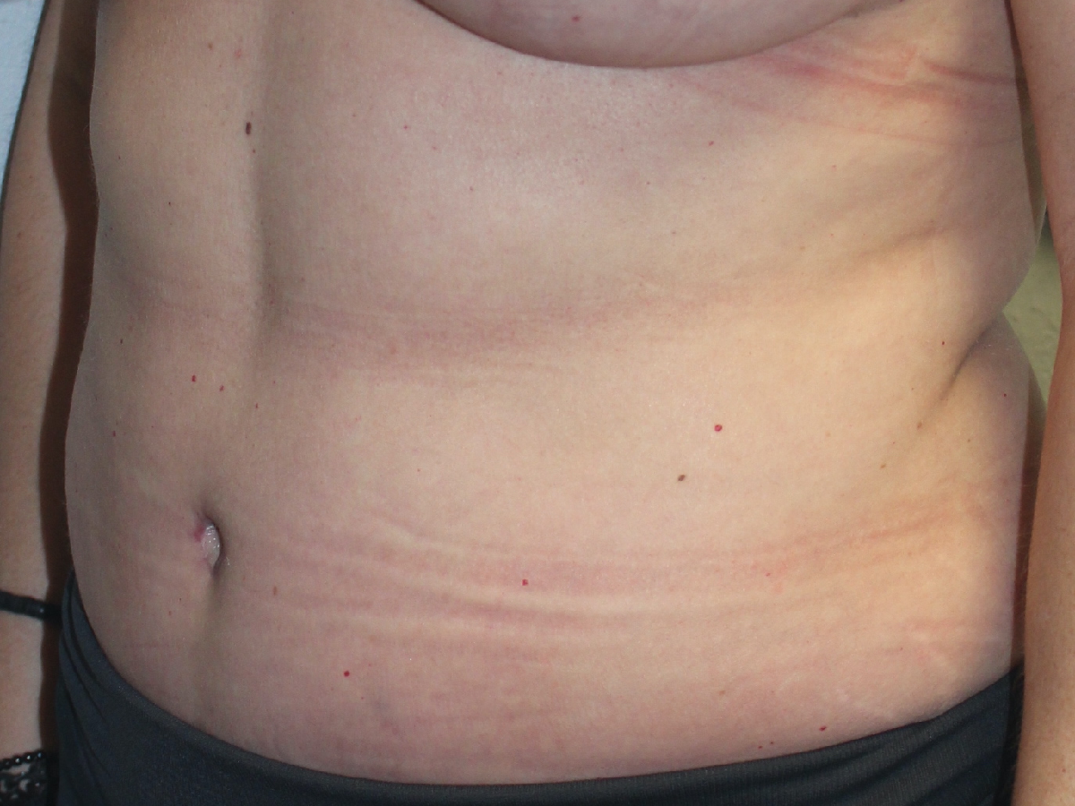 Before and after plastic surgery results in Dallas, TX, performed by Dr. Surjit Rai, MD.