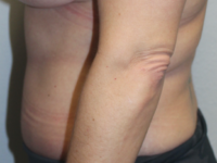 Before & After Photos: Breast Explant With Other Cosmetic Procedures
