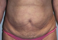 Before & After Photos: Breast Explant With Other Cosmetic Procedures