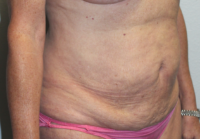 Before & After Photos: Breast Explant With Other Cosmetic Procedures