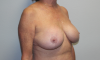 Breast Explant with Lift or Reduction