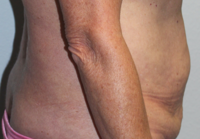 Before & After Photos: Breast Explant With Other Cosmetic Procedures