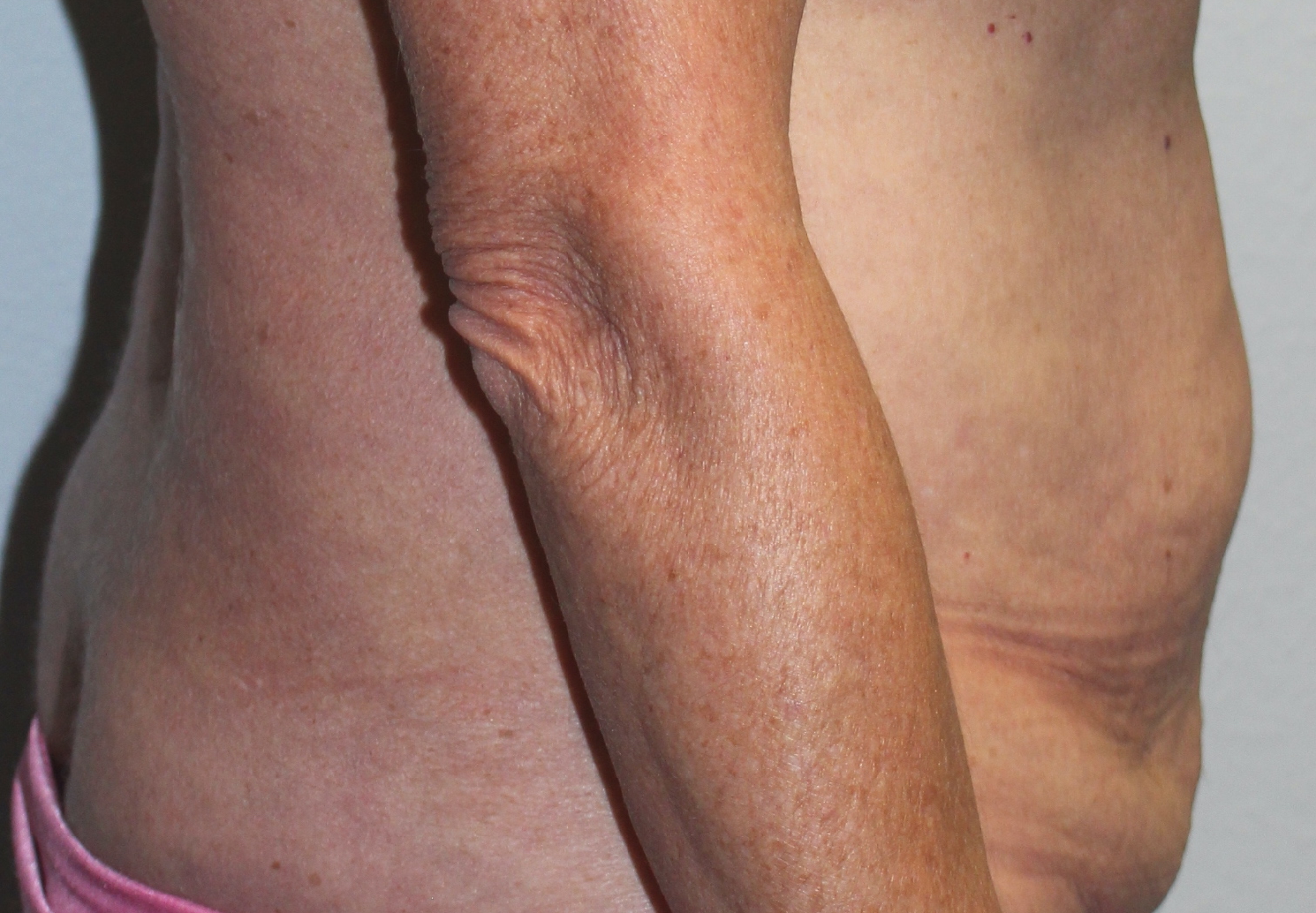 Before and after plastic surgery results in Dallas, TX, performed by Dr. Surjit Rai, MD.