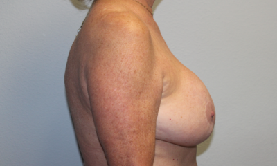 Breast Explant with Lift or Reduction
