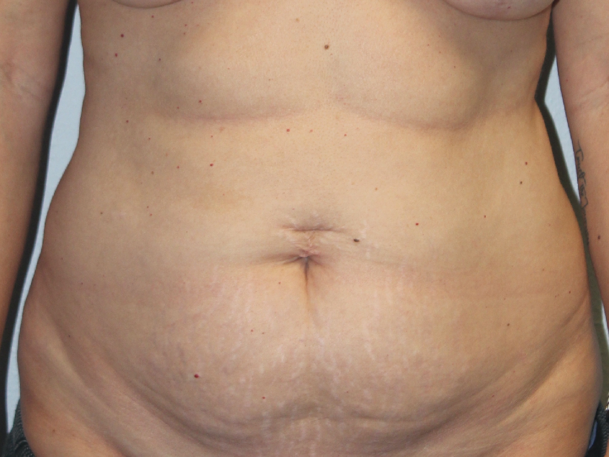 Before and after plastic surgery results in Dallas, TX, performed by Dr. Surjit Rai, MD.