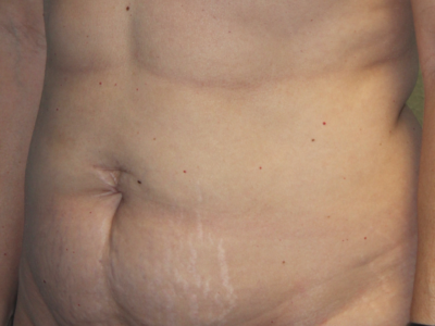 Before & After Photos: Breast Explant With Other Cosmetic Procedures
