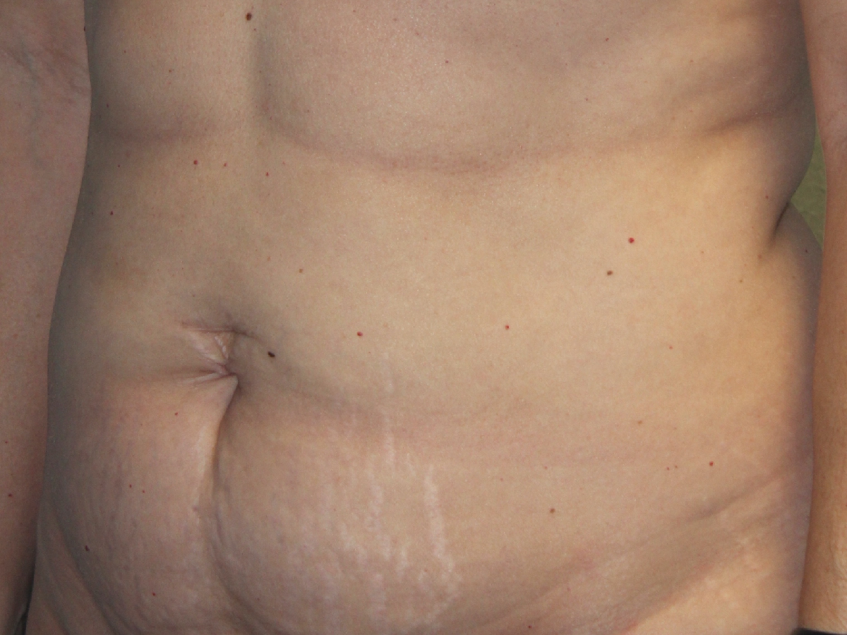 Before and after plastic surgery results in Dallas, TX, performed by Dr. Surjit Rai, MD.