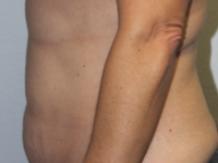 Before & After Photos: Breast Explant With Other Cosmetic Procedures
