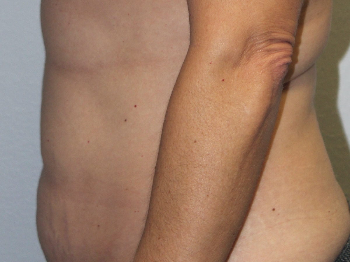 Before and after plastic surgery results in Dallas, TX, performed by Dr. Surjit Rai, MD.