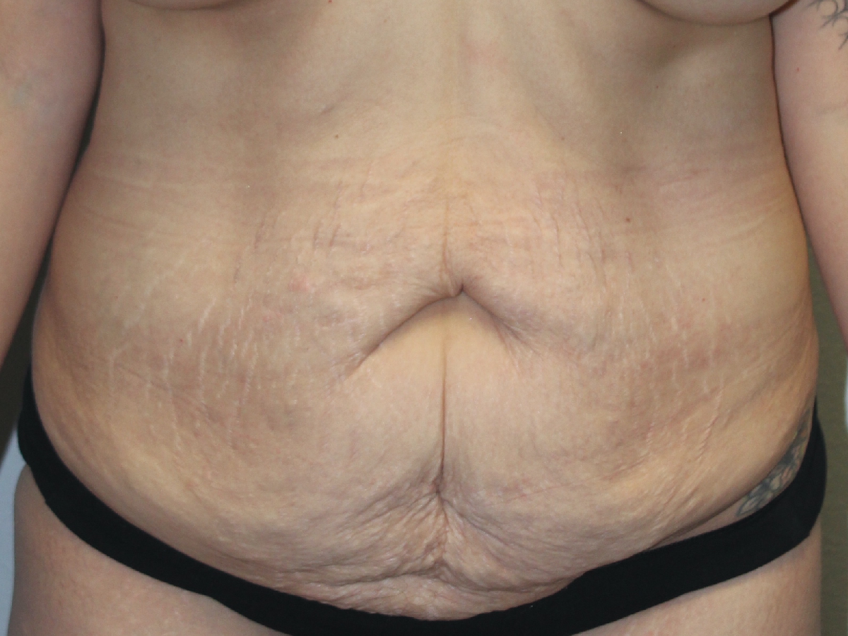 Before and after plastic surgery results in Dallas, TX, performed by Dr. Surjit Rai, MD.