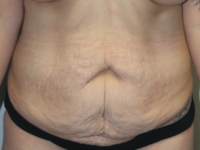 Before & After Photos: Breast Explant With Other Cosmetic Procedures