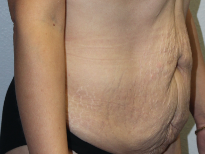 Before & After Photos: Breast Explant With Other Cosmetic Procedures
