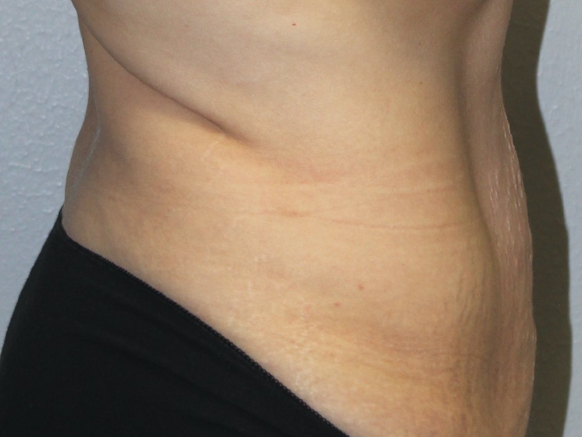 Before and after plastic surgery results in Dallas, TX, performed by Dr. Surjit Rai, MD.