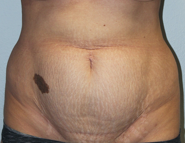 Before and after plastic surgery results in Dallas, TX, performed by Dr. Surjit Rai, MD.