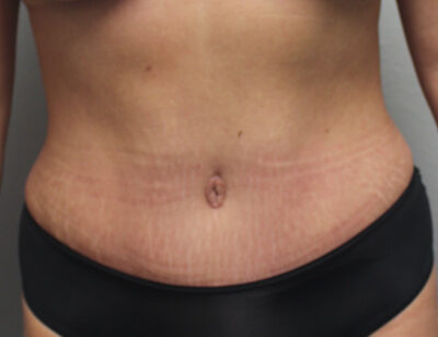 Breast Explant With Other Cosmetic Procedures