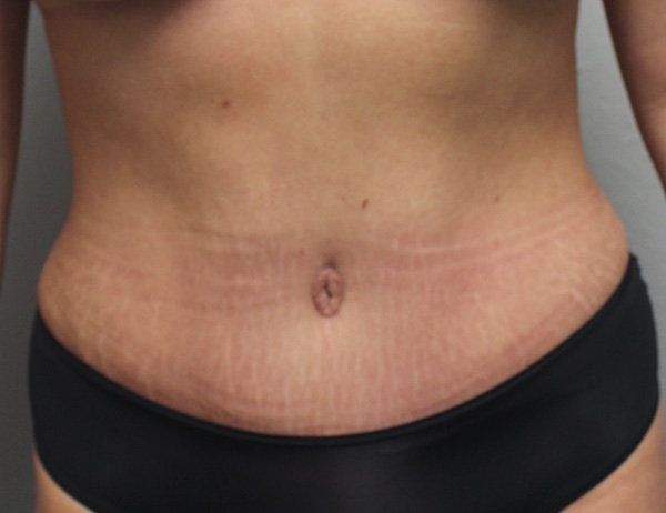 Before and after plastic surgery results in Dallas, TX, performed by Dr. Surjit Rai, MD.