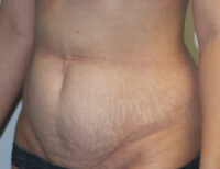 Before & After Photos: Breast Explant With Other Cosmetic Procedures