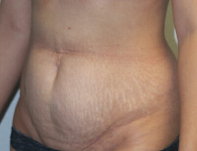 Breast Explant With Other Cosmetic Procedures