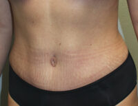 Before & After Photos: Breast Explant With Other Cosmetic Procedures