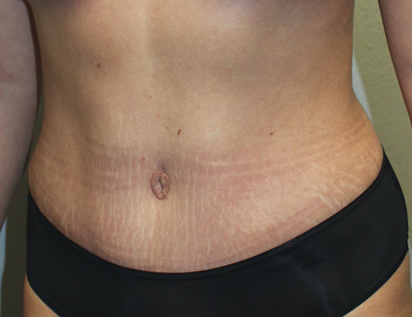 Before and after plastic surgery results in Dallas, TX, performed by Dr. Surjit Rai, MD.