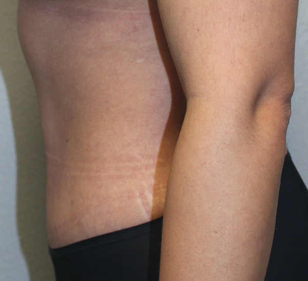 Before and after plastic surgery results in Dallas, TX, performed by Dr. Surjit Rai, MD.