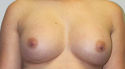 Before & After Photos: Breast Explant with Fat Transfer