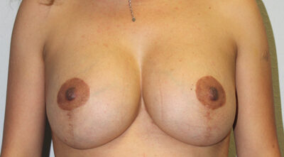 Breast Explant with Fat Transfer