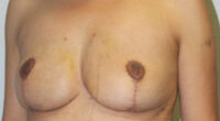 Breast Explant with Fat Transfer