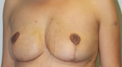 Before & After Photos: Breast Explant with Fat Transfer