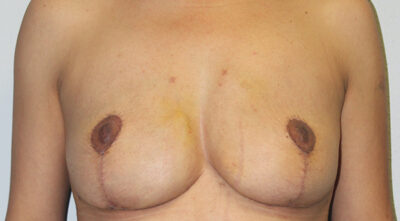 Before & After Photos: Breast Explant with Fat Transfer