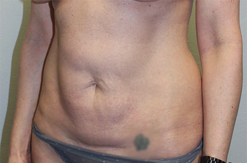 Before and after plastic surgery results in Dallas, TX, performed by Dr. Surjit Rai, MD.