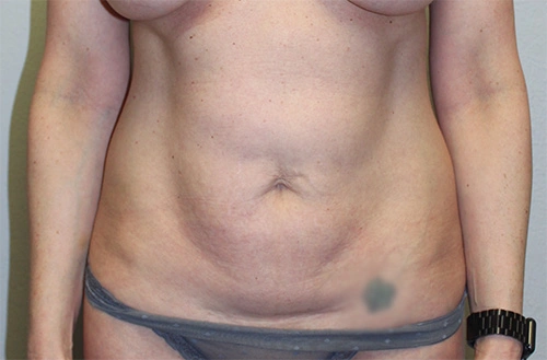 Before and after plastic surgery results in Dallas, TX, performed by Dr. Surjit Rai, MD.