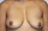 Before & After Photos Breast Explant