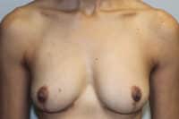 Before & After Photos: Breast Explant with Lift or Reduction