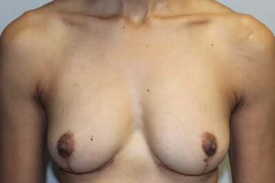 Before & After Photos: Breast Explant with Lift or Reduction