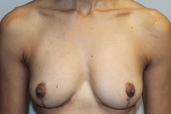 Before and after plastic surgery results in Dallas, TX, performed by Dr. Surjit Rai, MD.