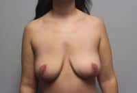 Before & After Photos: Breast Explant with Lift or Reduction