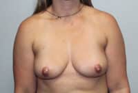 Before & After Photos: Breast Explant with Lift or Reduction