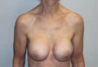 Before & After Photos: Breast Explant with Lift or Reduction