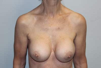 Before & After Photos: Breast Explant with Lift or Reduction