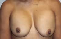 Before & After Photos Breast Explant