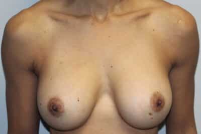 Before & After Photos: Breast Explant with Lift or Reduction