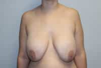 Before & After Photos: Breast Explant with Lift or Reduction