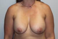 Before & After Photos: Breast Explant with Lift or Reduction