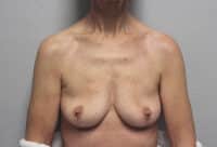 Before & After Photos: Breast Explant with Lift or Reduction