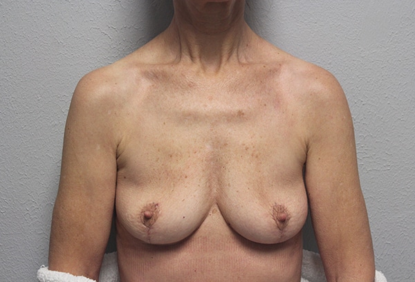 Before and after plastic surgery results in Dallas, TX, performed by Dr. Surjit Rai, MD.