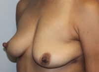 Before & After Photos Breast Explant