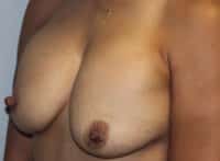 Before & After Photos Breast Explant